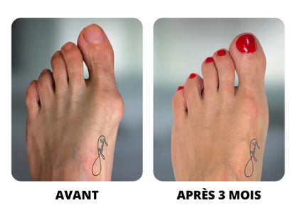 ATTELLE D'HALLUX VALGUS AVEC CORRECTION