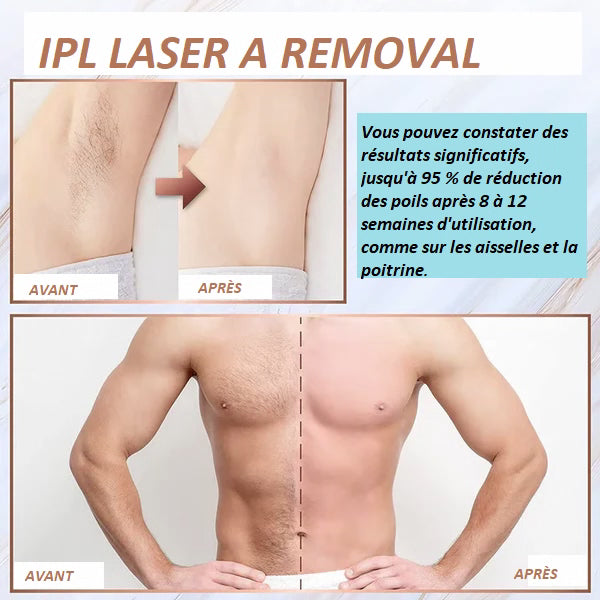 EPILATEUR LASER