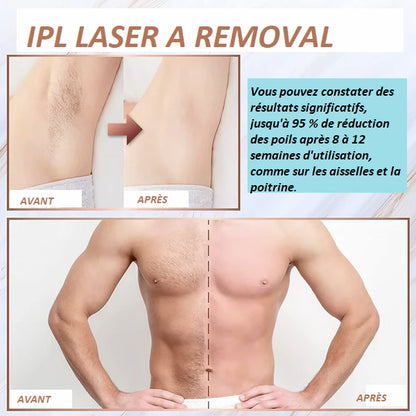 EPILATEUR LASER